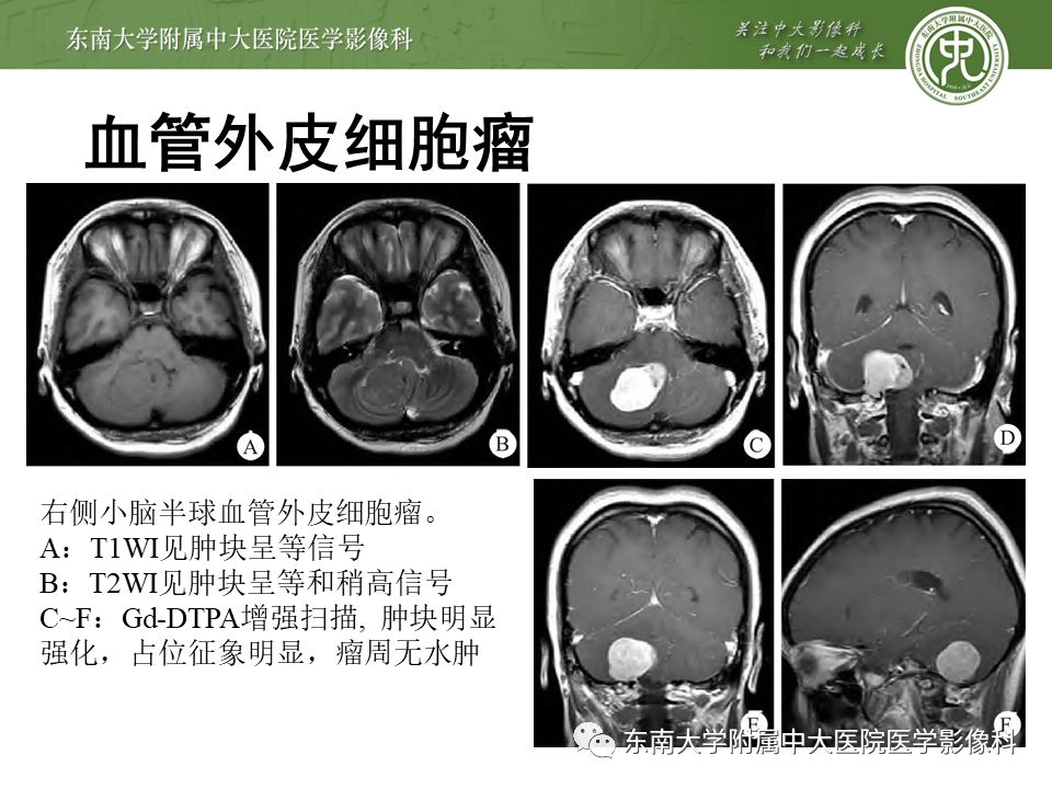 【病例】颅内血管外皮细胞瘤1例MR
