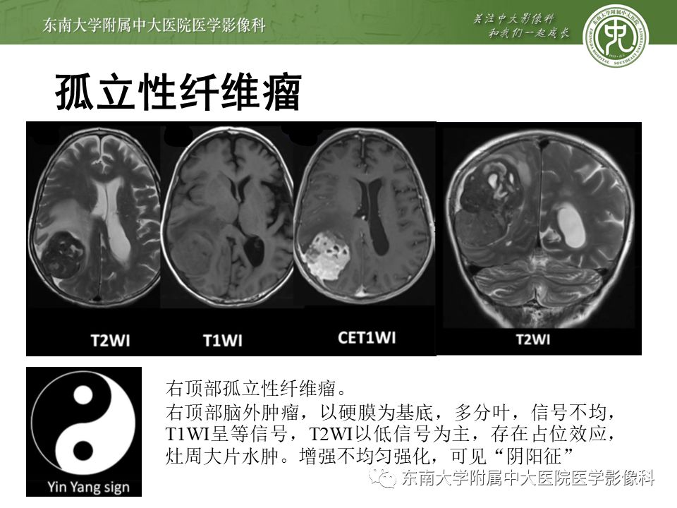 【病例】颅内血管外皮细胞瘤1例MR