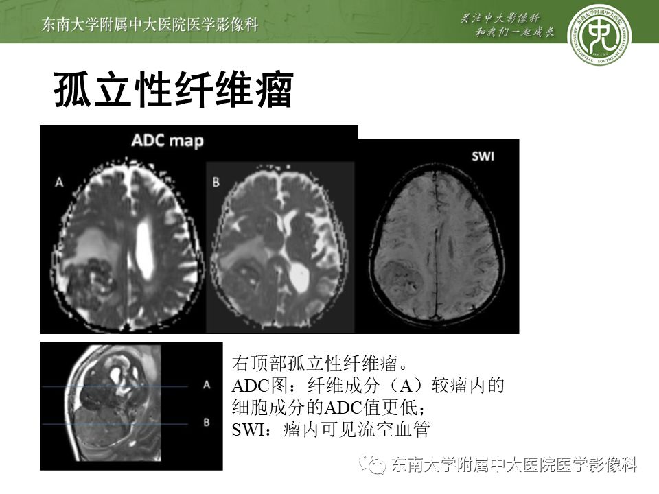 【病例】颅内血管外皮细胞瘤1例MR