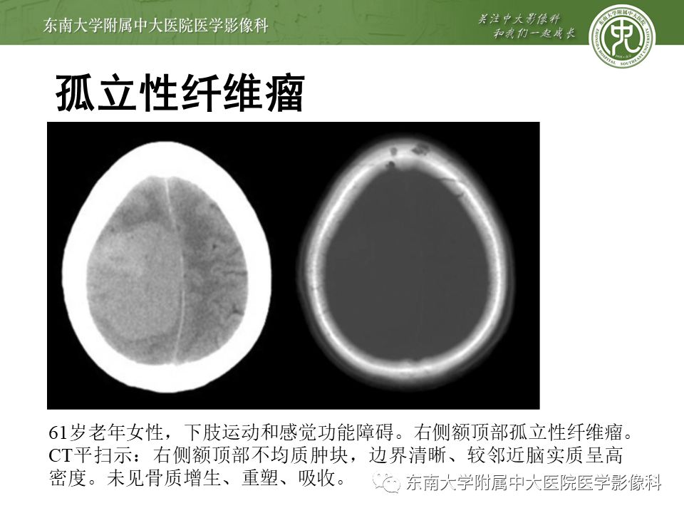 【病例】颅内血管外皮细胞瘤1例MR
