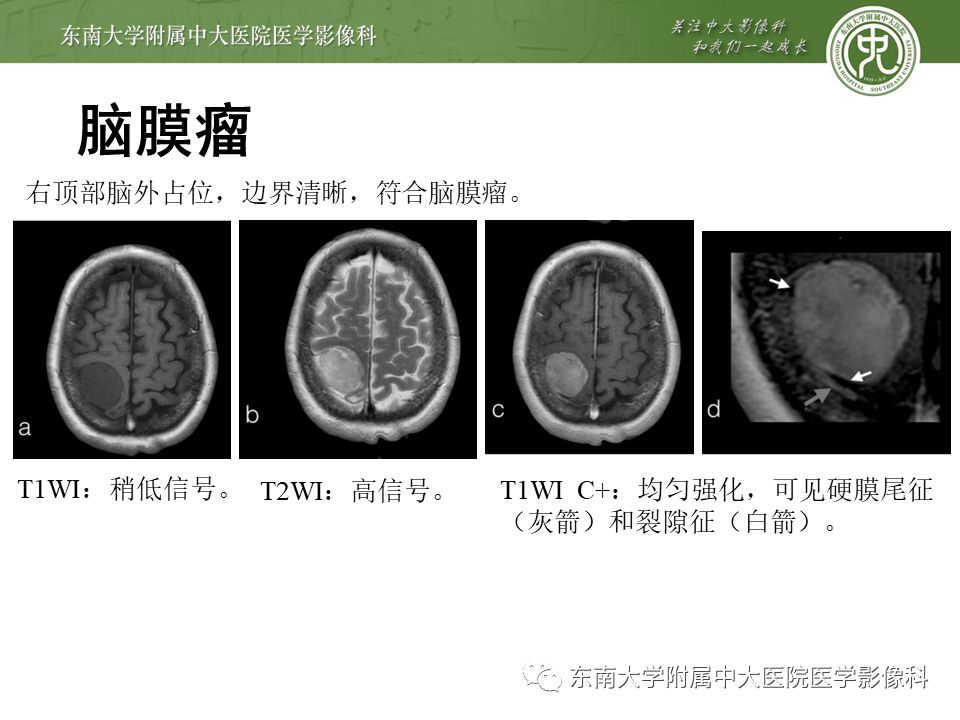 【病例】颅内血管外皮细胞瘤1例MR