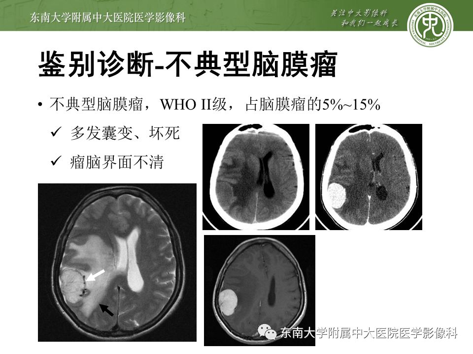 【病例】颅内血管外皮细胞瘤1例MR