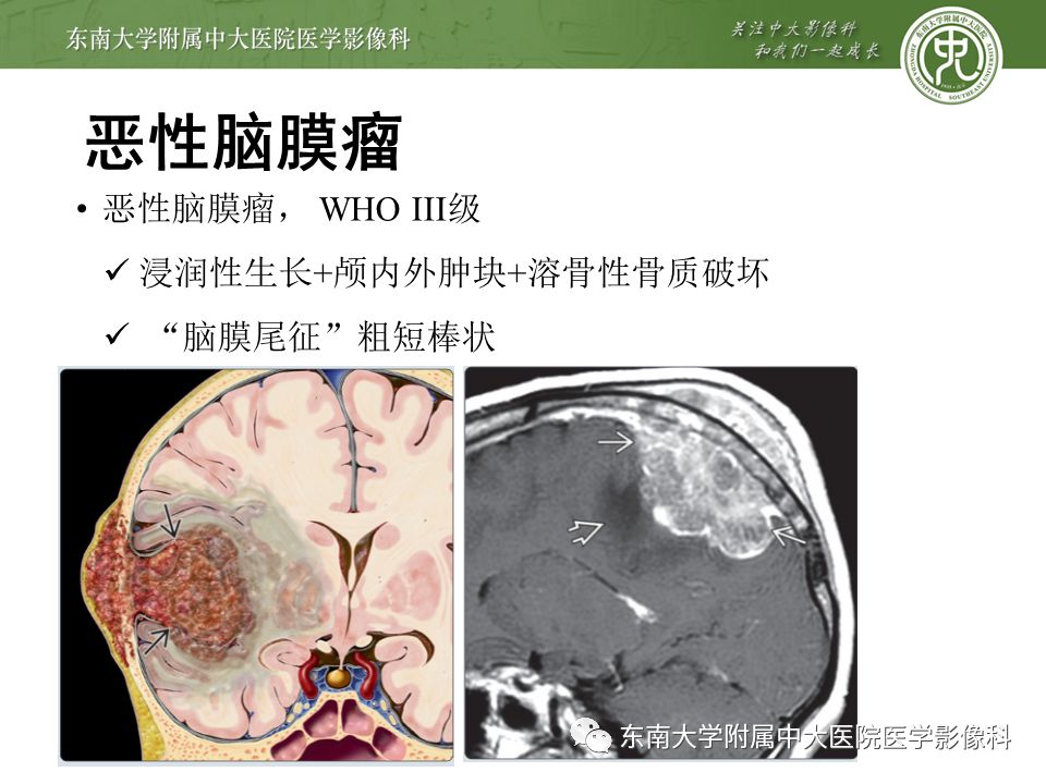 【病例】颅内血管外皮细胞瘤1例MR