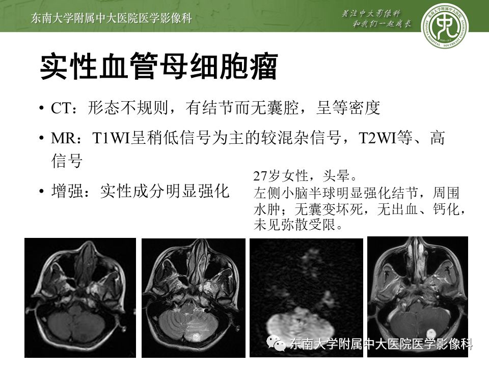 【病例】颅内血管外皮细胞瘤1例MR