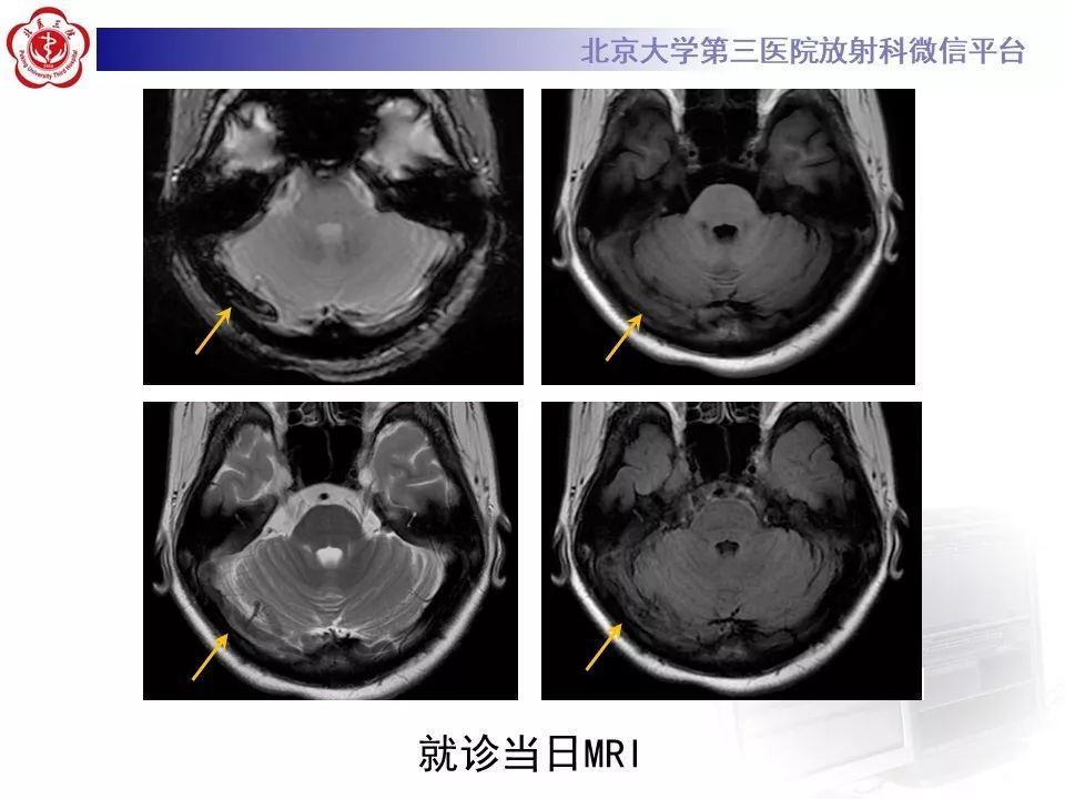 【病例】静脉窦血栓形成1例CT及MR影像