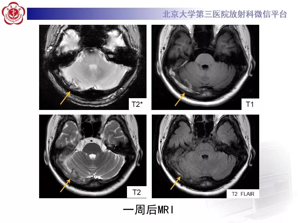 【病例】静脉窦血栓形成1例CT及MR影像