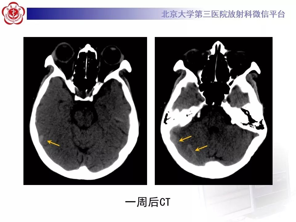 【病例】静脉窦血栓形成1例CT及MR影像