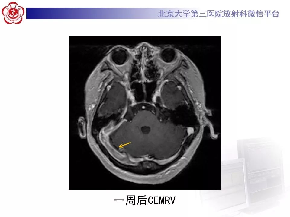 【病例】静脉窦血栓形成1例CT及MR影像