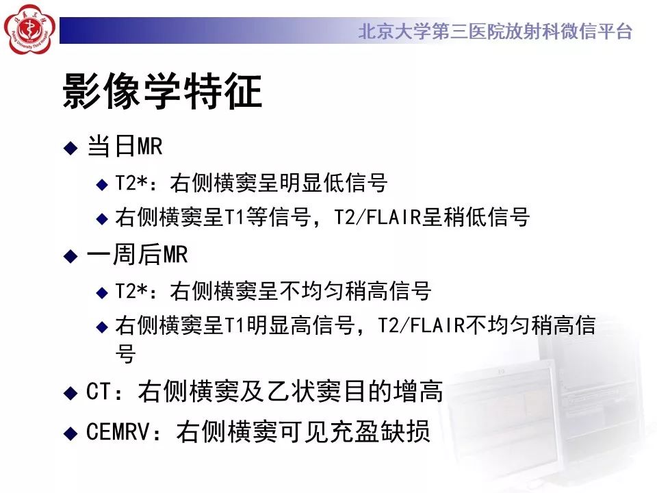 【病例】静脉窦血栓形成1例CT及MR影像