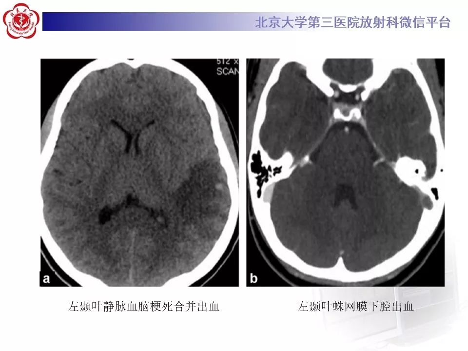 【病例】静脉窦血栓形成1例CT及MR影像