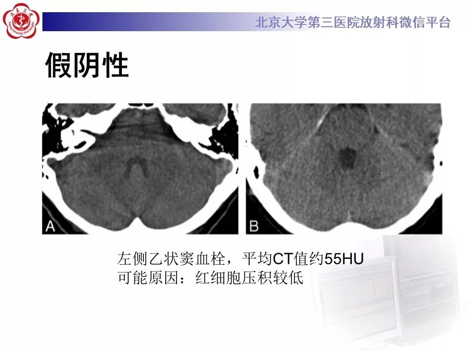 【病例】静脉窦血栓形成1例CT及MR影像