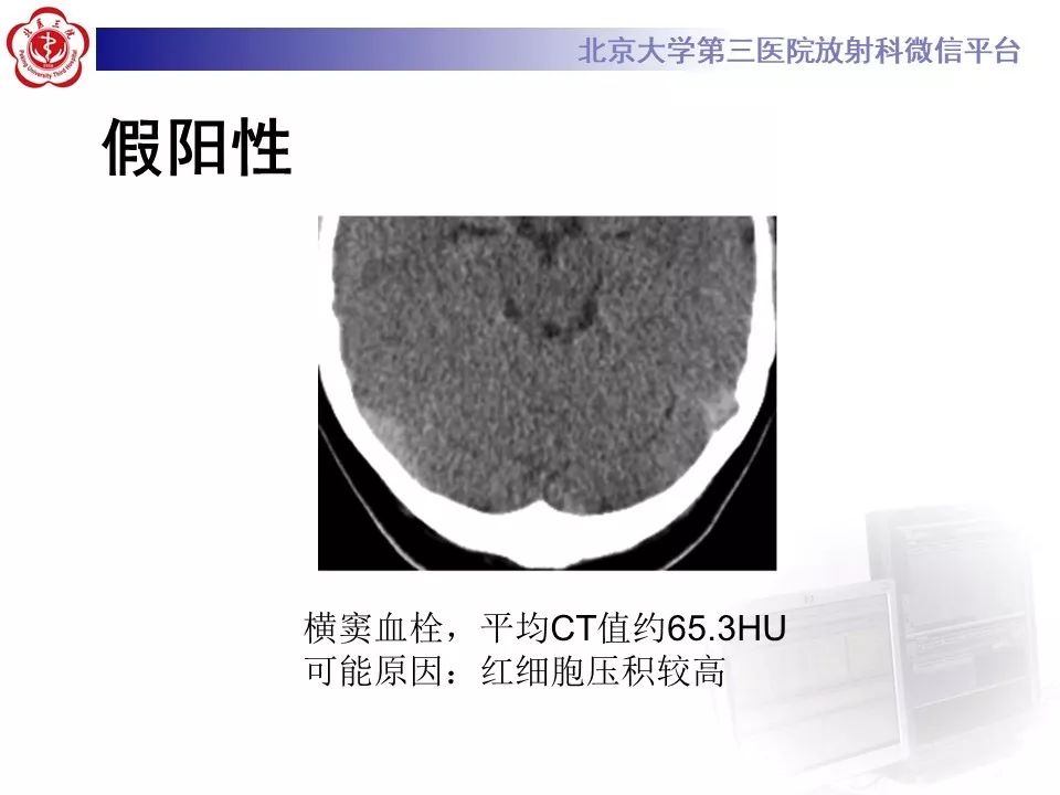 【病例】静脉窦血栓形成1例CT及MR影像