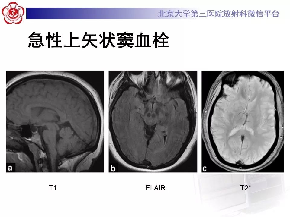 【病例】静脉窦血栓形成1例CT及MR影像