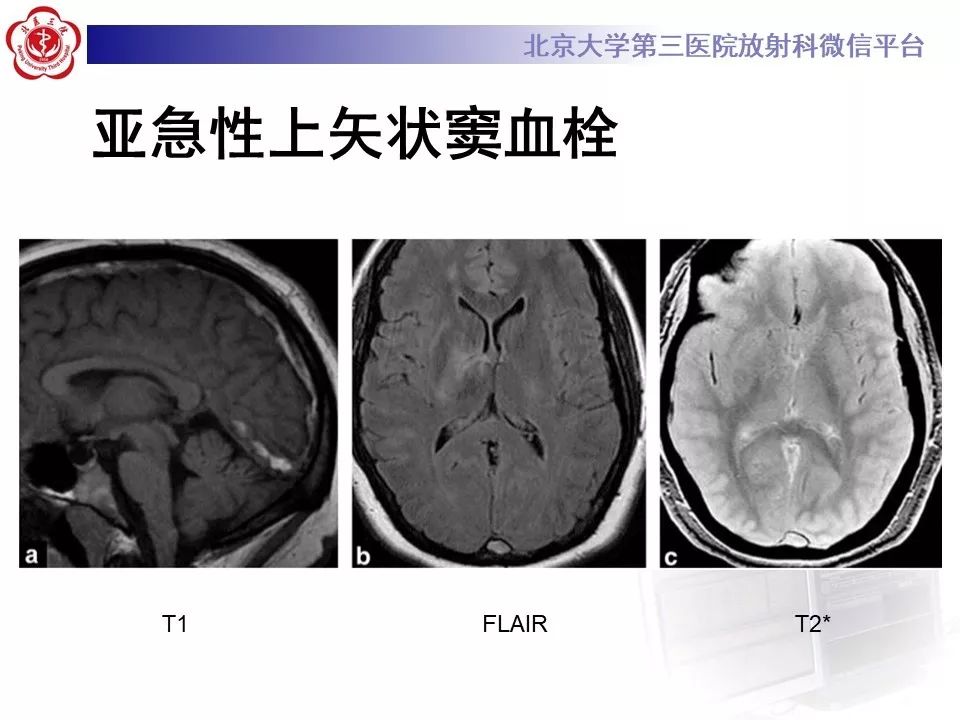 【病例】静脉窦血栓形成1例CT及MR影像