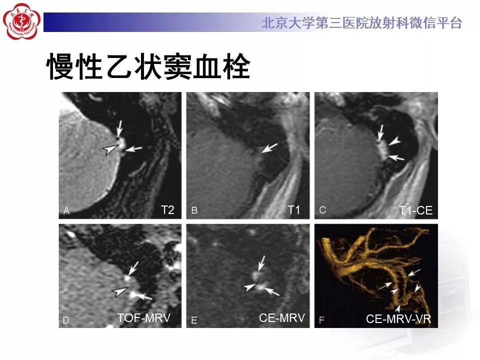 【病例】静脉窦血栓形成1例CT及MR影像