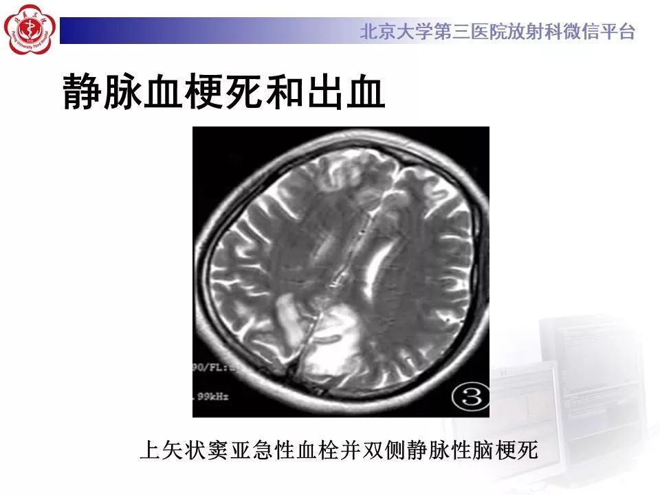 【病例】静脉窦血栓形成1例CT及MR影像