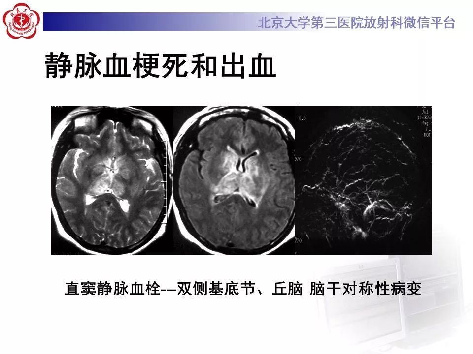 【病例】静脉窦血栓形成1例CT及MR影像