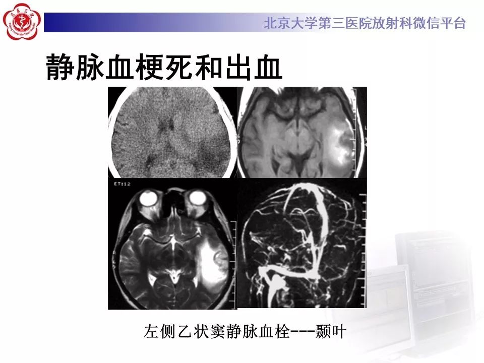 【病例】静脉窦血栓形成1例CT及MR影像