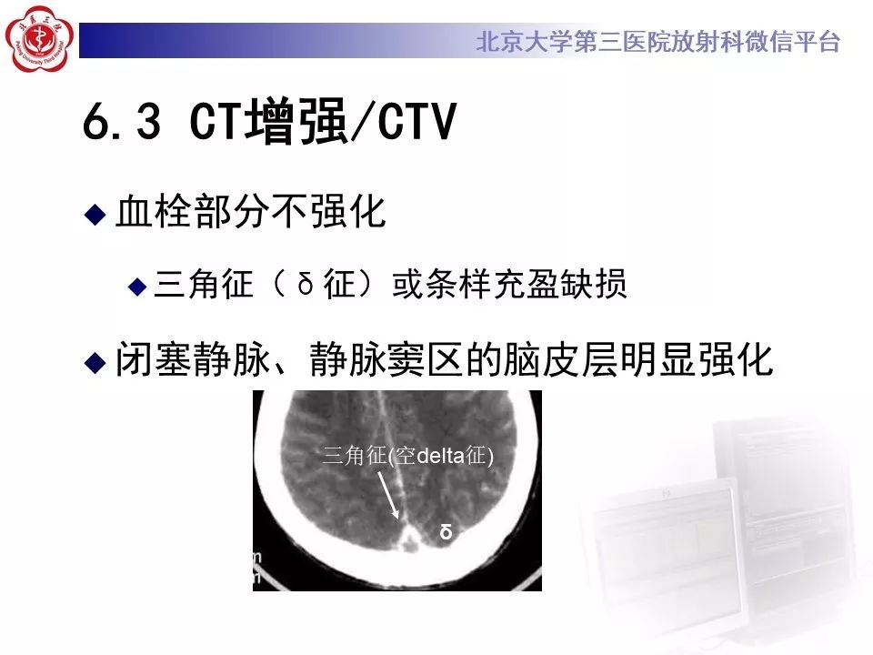 【病例】静脉窦血栓形成1例CT及MR影像