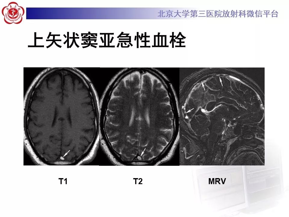 【病例】静脉窦血栓形成1例CT及MR影像
