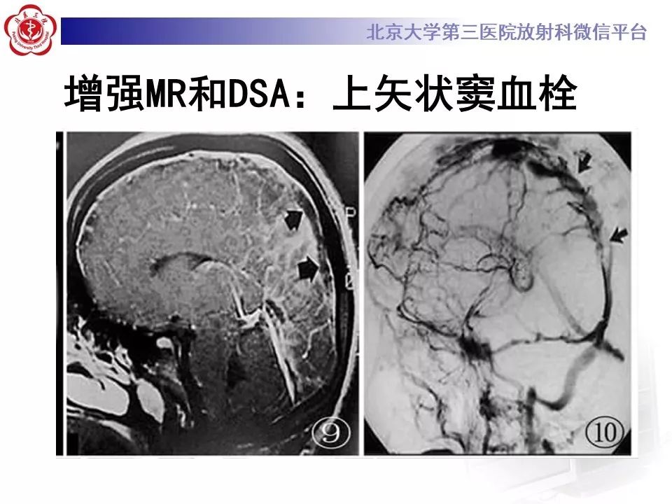 【病例】静脉窦血栓形成1例CT及MR影像