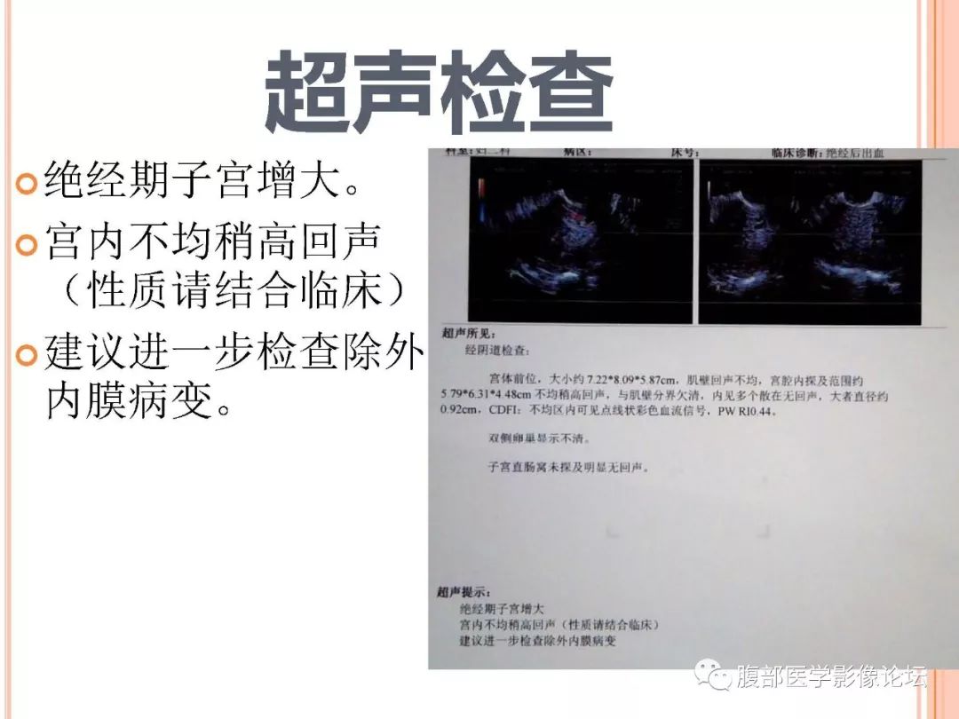 【病例】子宫内膜息肉1例MR影像