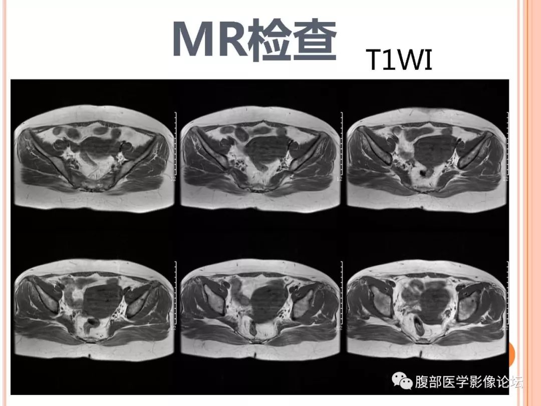 【病例】子宫内膜息肉1例MR影像