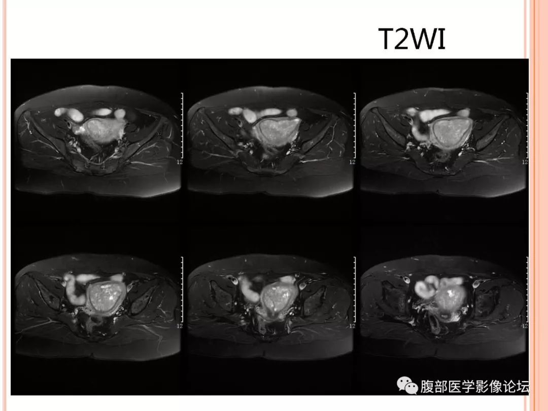 【病例】子宫内膜息肉1例MR影像