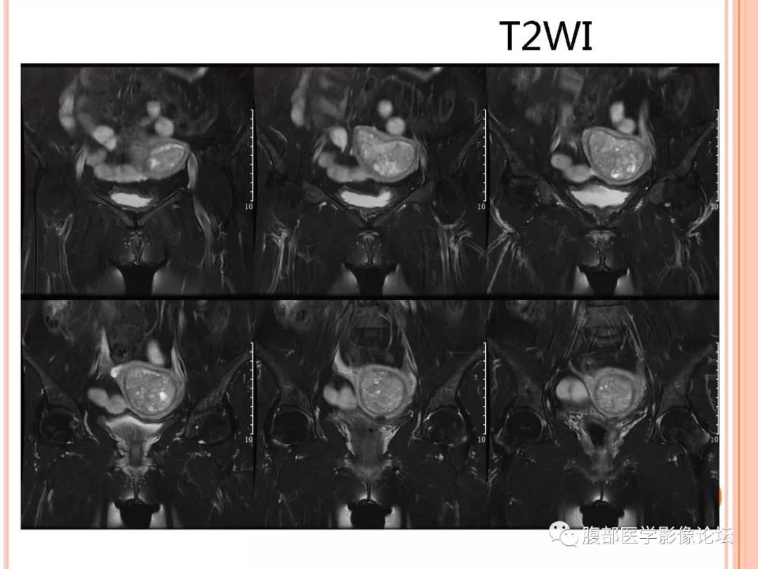 【病例】子宫内膜息肉1例MR影像