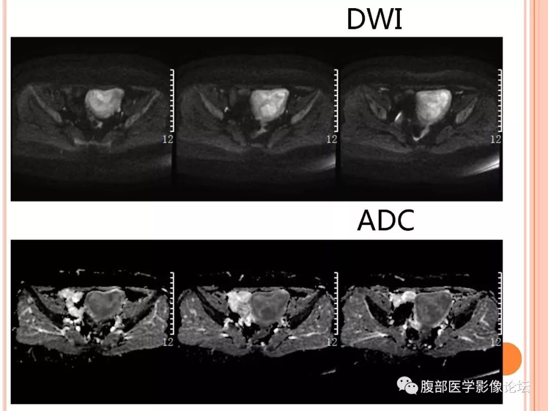 【病例】子宫内膜息肉1例MR影像