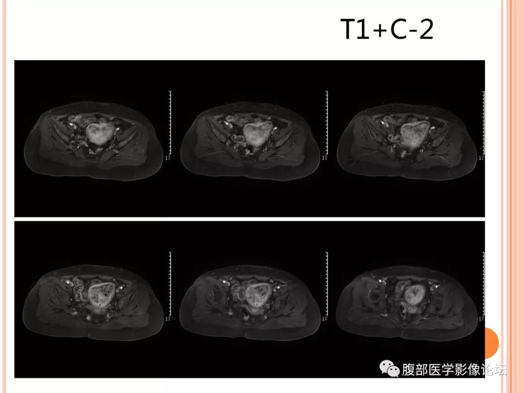 【病例】子宫内膜息肉1例MR影像