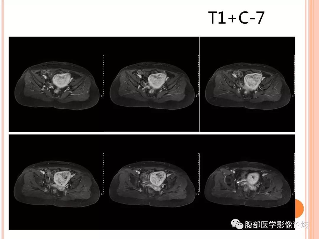 【病例】子宫内膜息肉1例MR影像