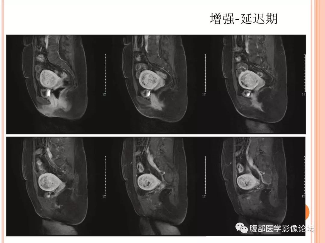 【病例】子宫内膜息肉1例MR影像