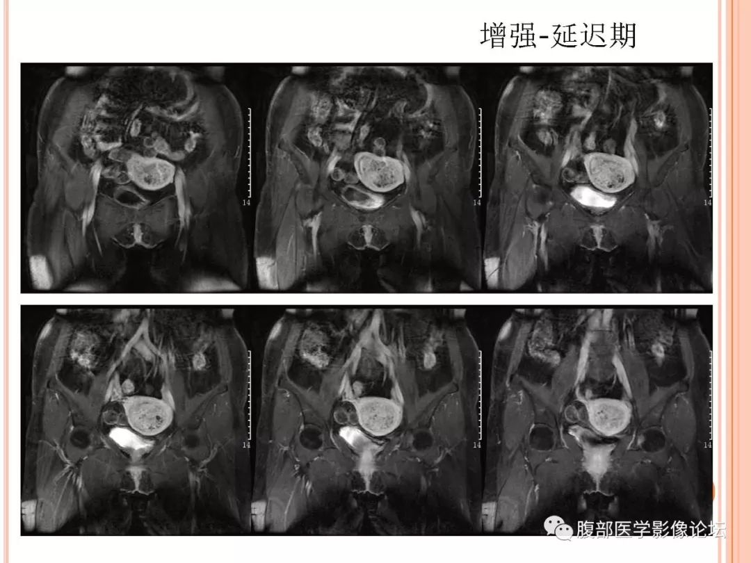 【病例】子宫内膜息肉1例MR影像