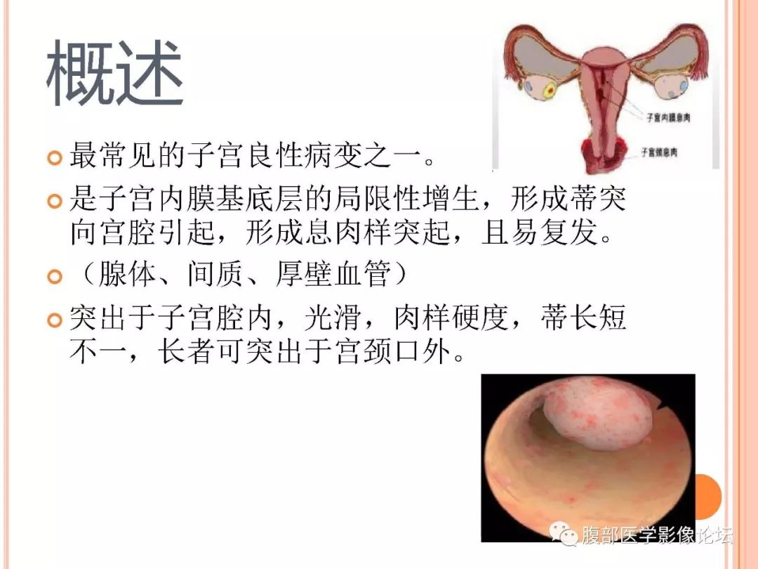 【病例】子宫内膜息肉1例MR影像
