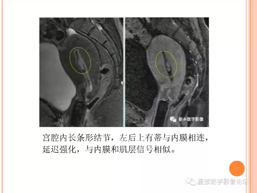 【病例】子宫内膜息肉1例MR影像