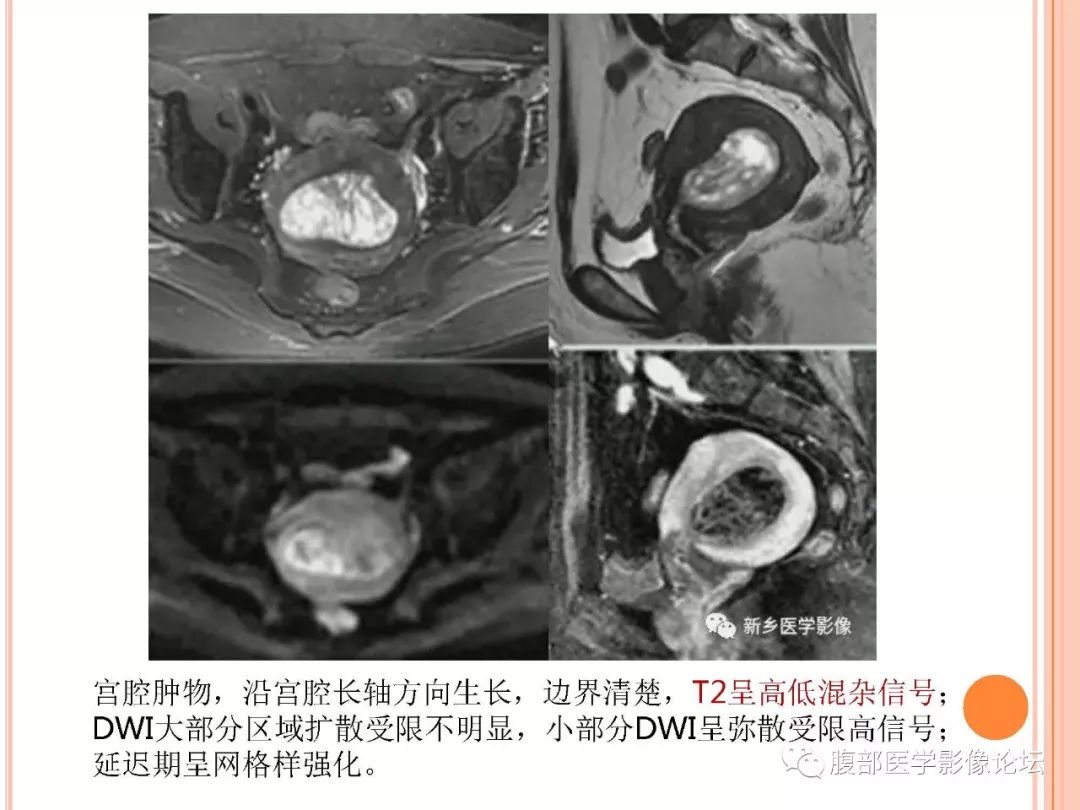 【病例】子宫内膜息肉1例MR影像