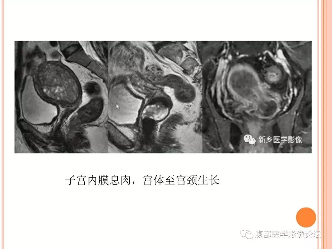 【病例】子宫内膜息肉1例MR影像