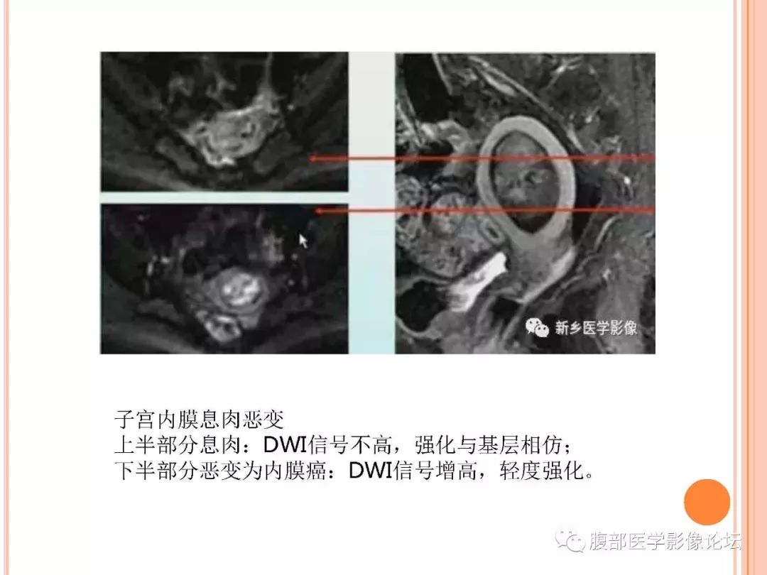 【病例】子宫内膜息肉1例MR影像