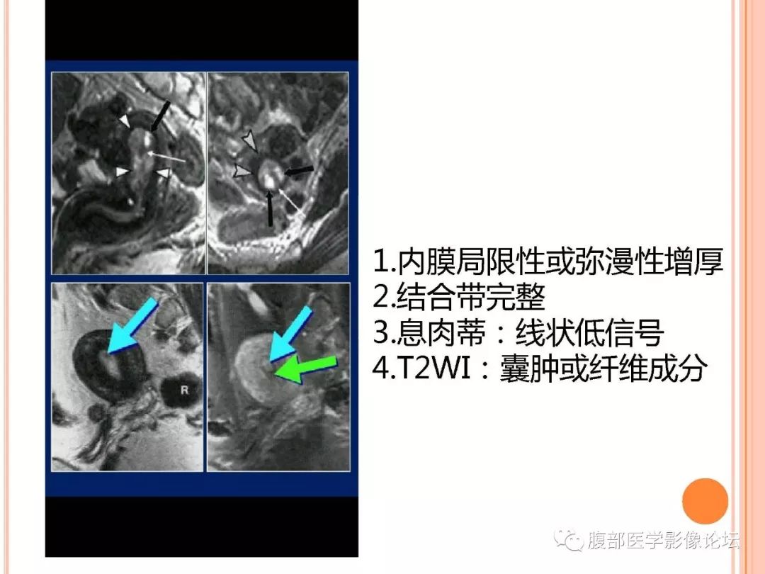 【病例】子宫内膜息肉1例MR影像