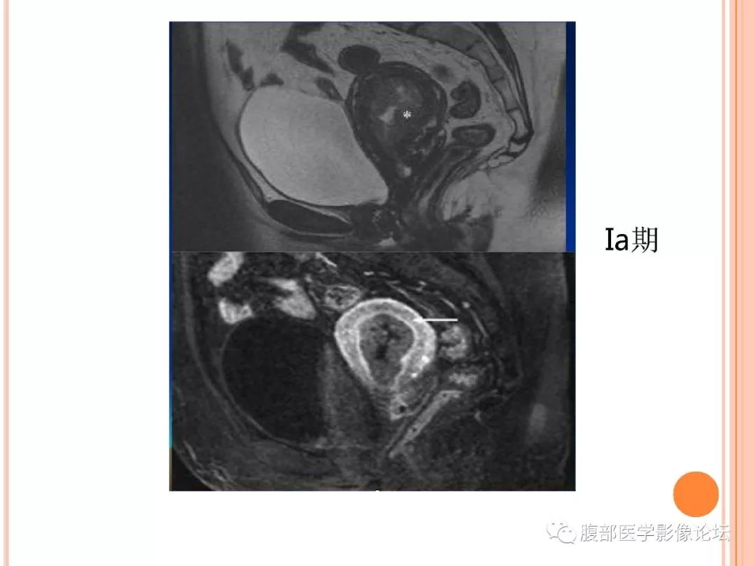【病例】子宫内膜息肉1例MR影像