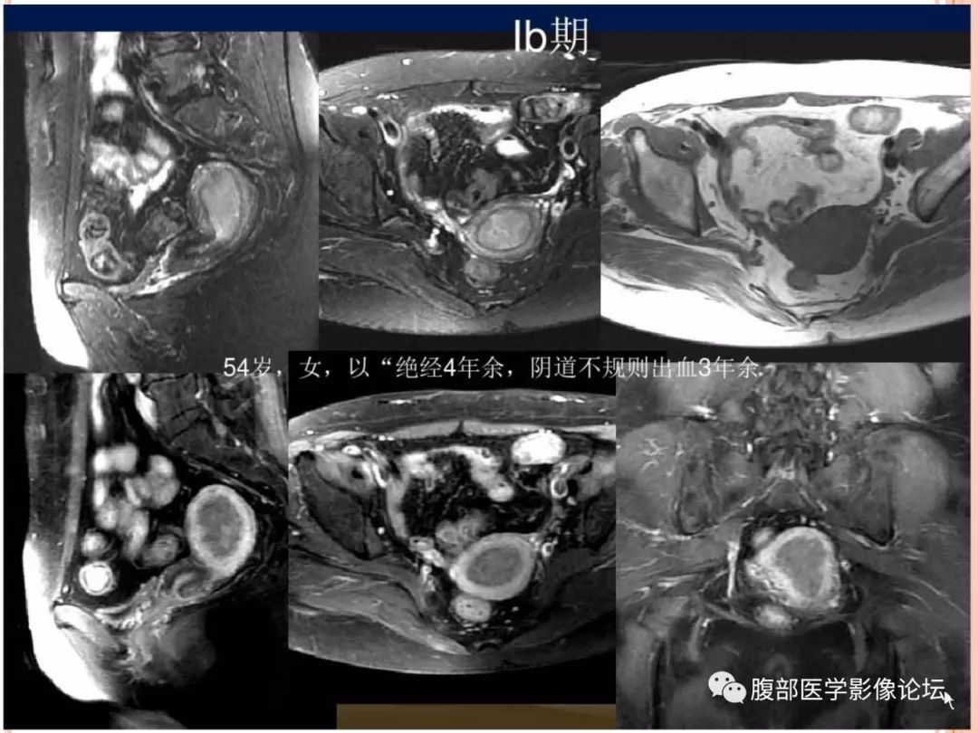 【病例】子宫内膜息肉1例MR影像