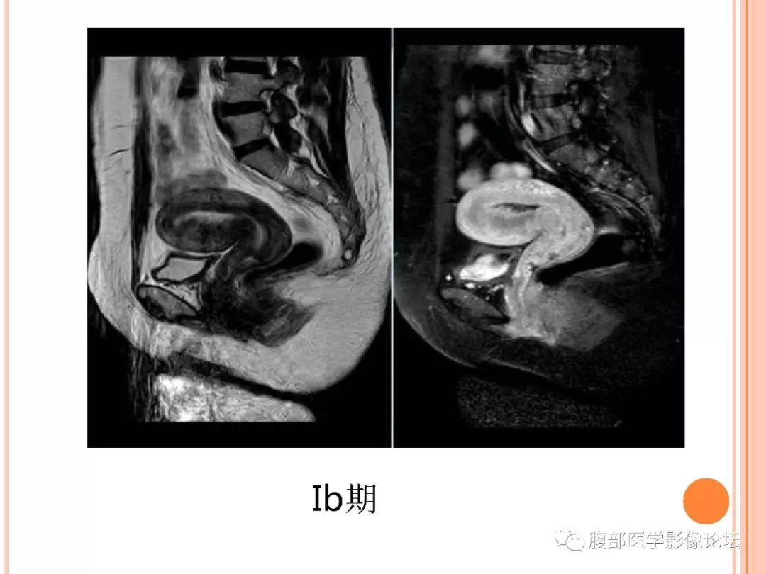 【病例】子宫内膜息肉1例MR影像