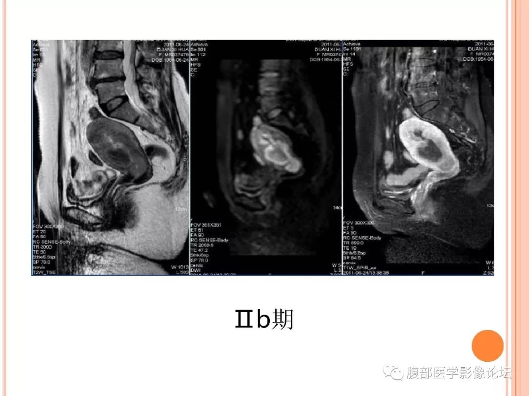 【病例】子宫内膜息肉1例MR影像