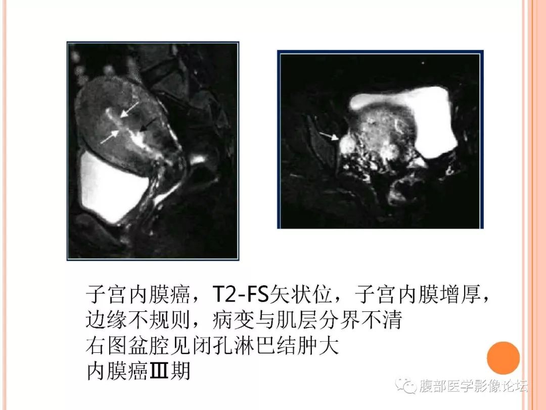 【病例】子宫内膜息肉1例MR影像