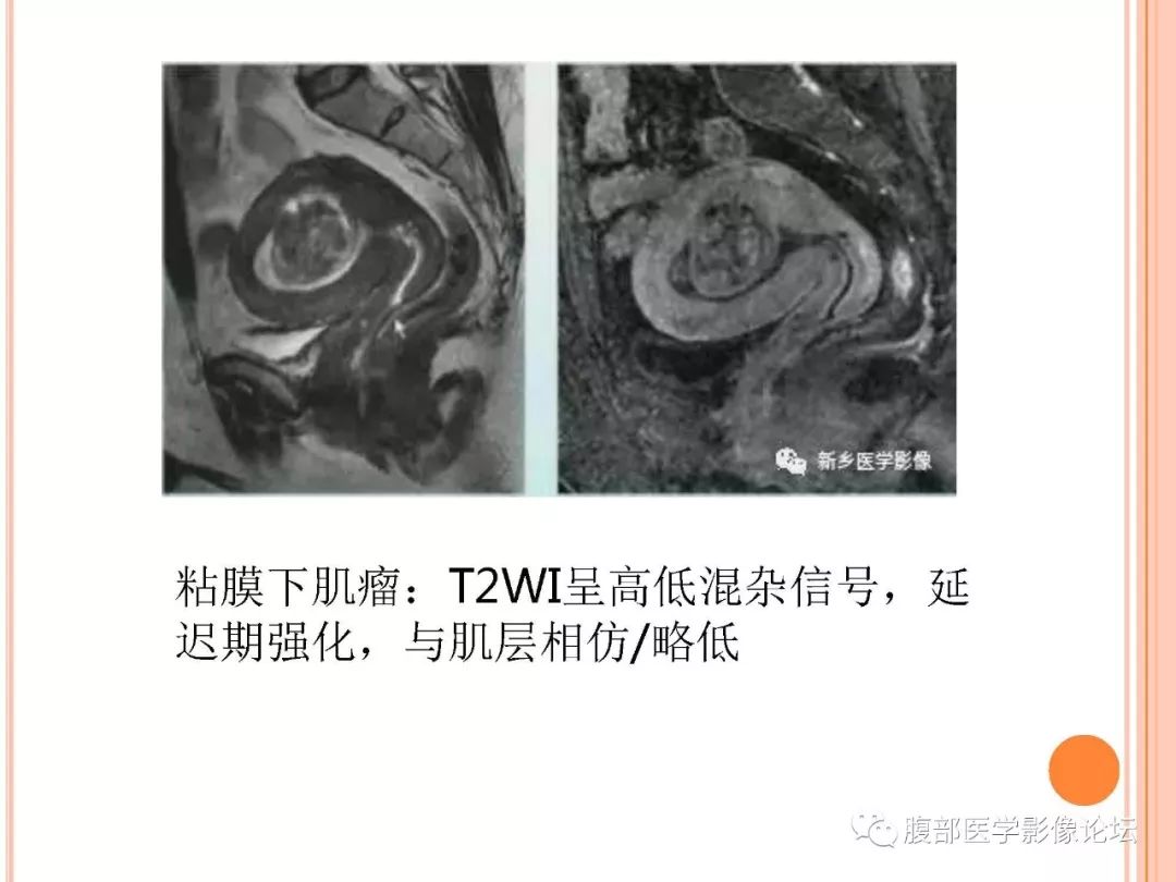 【病例】子宫内膜息肉1例MR影像