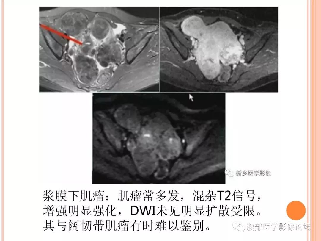 【病例】子宫内膜息肉1例MR影像