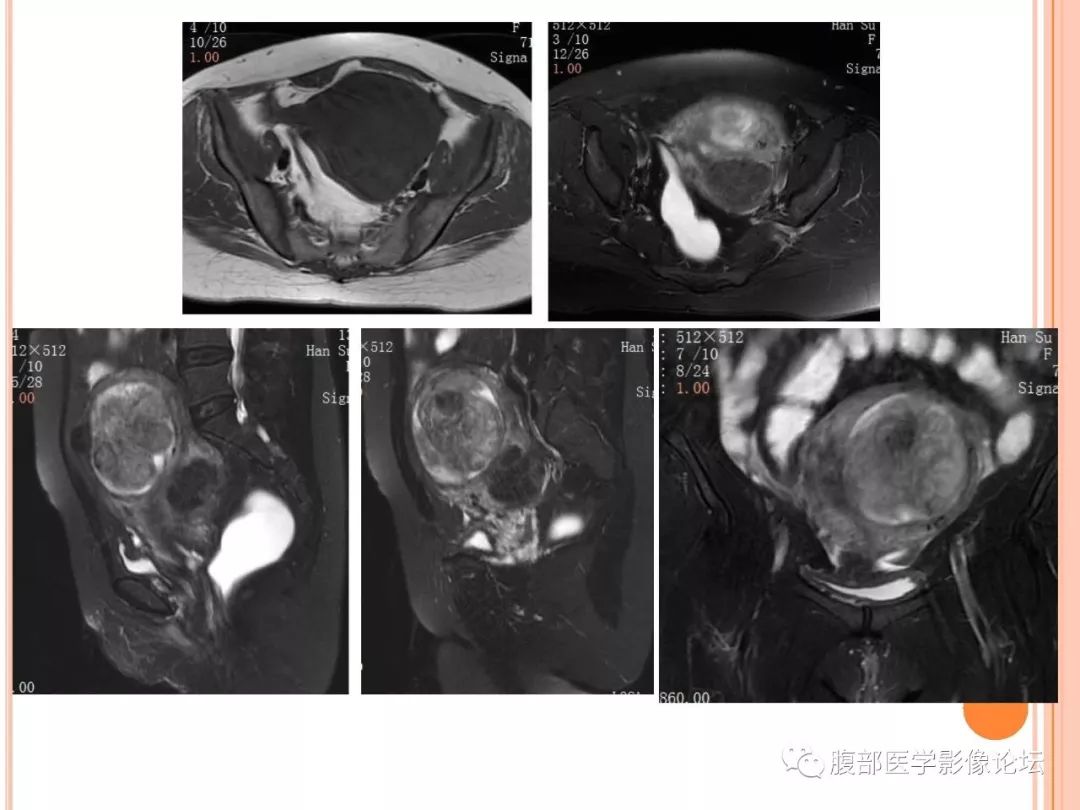 【病例】子宫内膜息肉1例MR影像