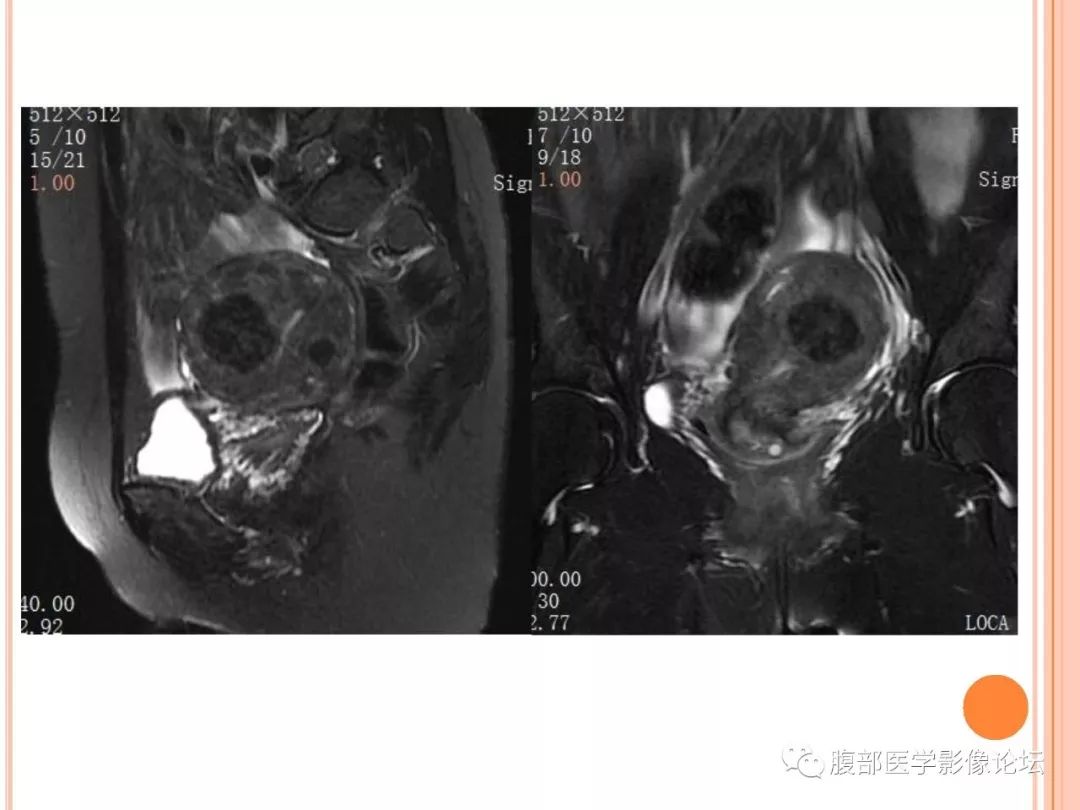 【病例】子宫内膜息肉1例MR影像