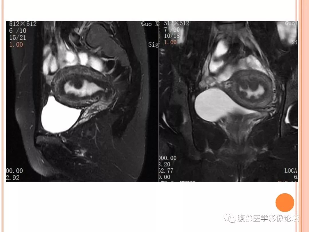 【病例】子宫内膜息肉1例MR影像